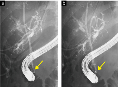 症例3　Cアームの角度付けの効果 a：カテーテル先端が内視鏡と重なり，確認できない。 b：Cアームの角度を変え，カテーテル先端が確認できる。