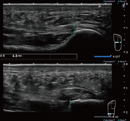 図1　足底腱膜炎の診断 上：正常例　下：足底腱膜の肥厚