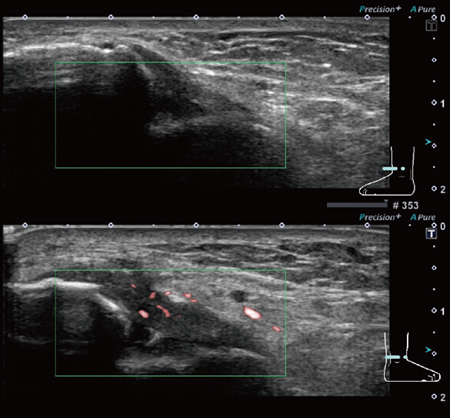 図2　SMIによる微細血流の描出 上：正常例　下：前距腓靭帯損傷