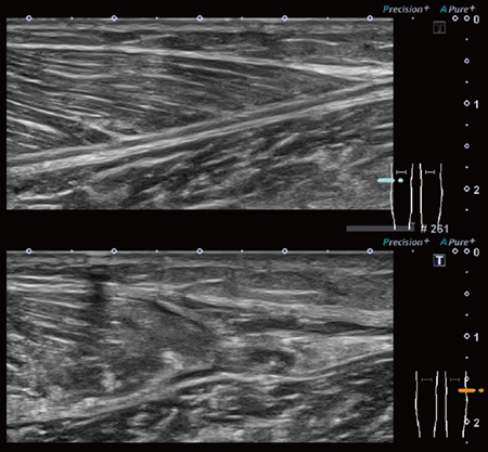 図3　腓腹筋損傷 上：正常例　下：損傷例