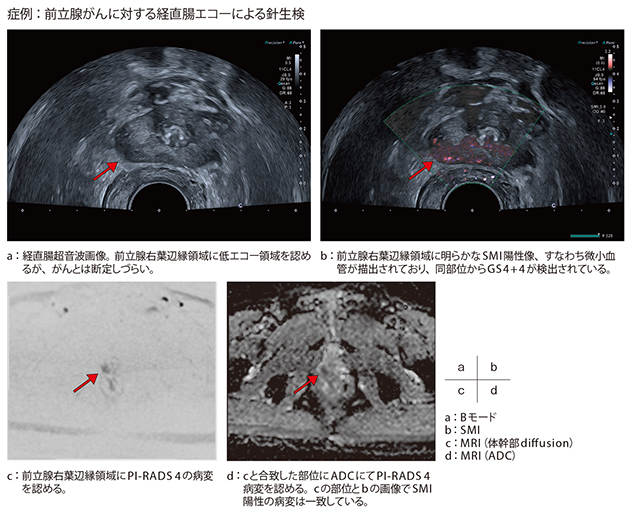 症例：前立腺がんに対する経直腸エコーによる針生検