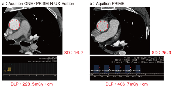 図1　同一患者の冠動脈CT