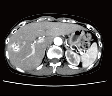 図2　肝血管腫　低管電圧撮影（80kV）にて3相撮影を実施 低管電圧撮影により造影剤量を4割程度低減している。