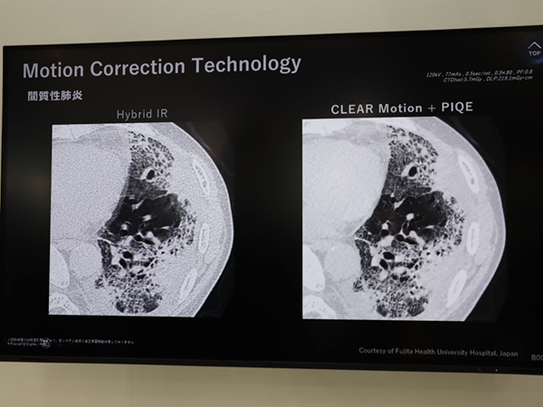 体動補正技術「CLEAR Motion」と「PIQE」の併用で肺野領域の高画質化と被ばく低減を実現