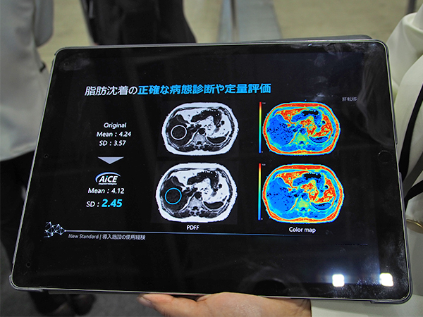 “Fat Fraction Quantification”での定量評価にもAiCEを適応