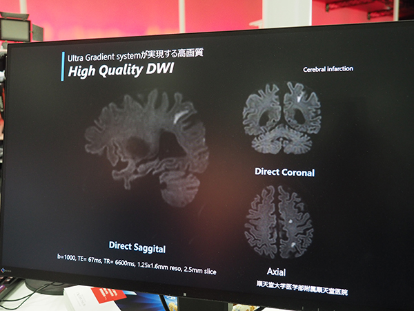 Ultra Gradient systemで描出された歪みの少ない“High Quality DWI”