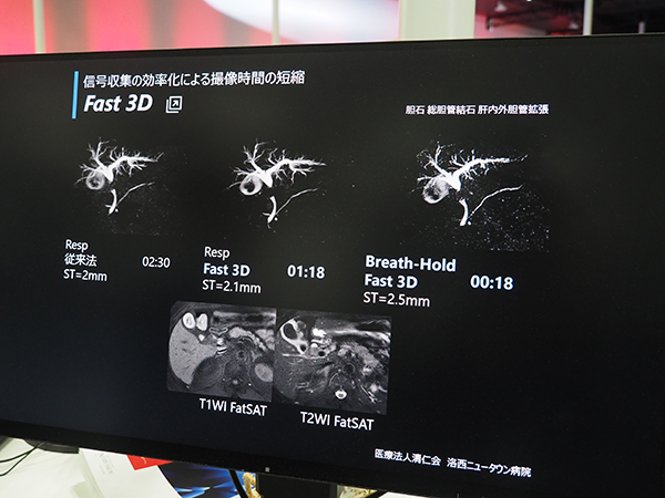 信号収集の効率化で撮像時間を短縮する“Fast 3D”。18秒で1回の息止めでMRCPの撮像が可能。