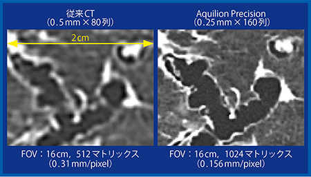 図3　単純拡大した際の従来CTとの画質の違い（8倍拡大）