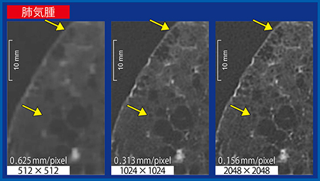 図5　Aquilion Precisionのマトリックス差による画質比較