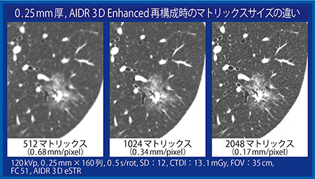 図6　症例提示：肺がん疑い症例におけるマトリックス差による画質比較