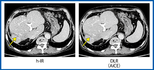 図2　大腸がん肝転移における画質比較1）