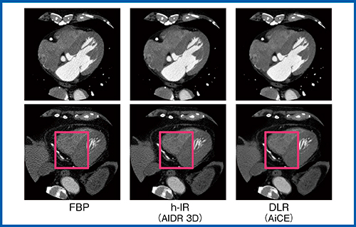 図6　心臓CTにおける画質の比較