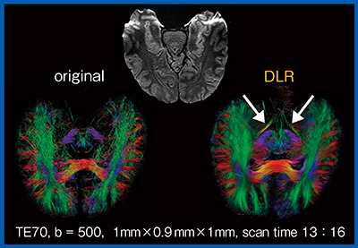 図4　拡散テンソルトラクトグラフィにおけるDLRの効果