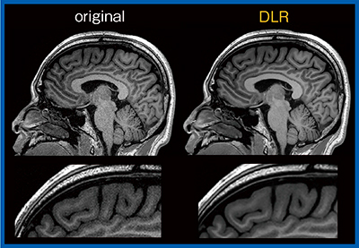 図5　0.8mm iso voxel MPRAGE画像におけるノイズの低減