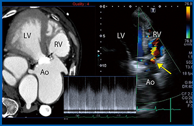 図4　症例3：62歳，VSD術後 大動脈弁置換術後，Smart Fusion