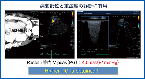 図5　症例4：40歳，修正大血管転位 Rastelli術後，Smart Fusion