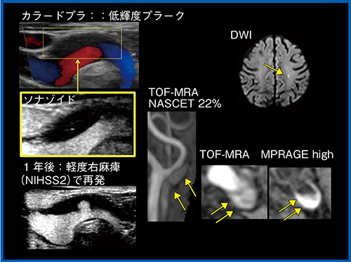 図1　軽度狭窄のある脳梗塞再発例