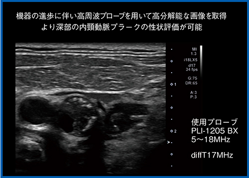 図2　17MHz高周波プローブによるプラークの性状評価