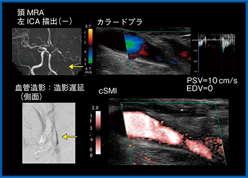 図3　偽閉塞症例におけるSMI（color-coded SMI：cSMI）