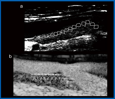 図2　GSMとソナゾイド造影超音波でのROI設定 a：GSM　b：相対的造影剤増強効果