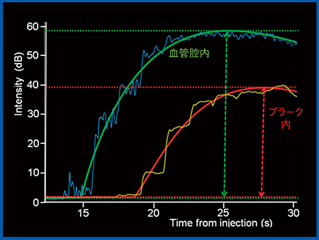 図3　ソナゾイド造影超音波における血管内腔とプラークのTIC