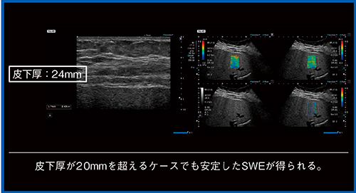 図6　Aplio i800による皮下厚が20mmを超えるNAFLD症例