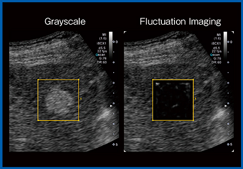 図8　新・ゆらぎイメージング（W.I.P.）による肝細胞がん
