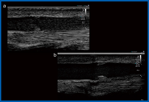 図10　超・超高周波プローブによる静脈弁の描出 a：Ultra HFP（24MHz）　 b：Super HFP（33MHz）（W.I.P.）