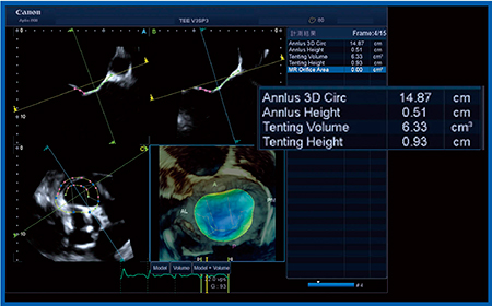 図6　症例2：Mitral Valve Analysisによる僧帽弁閉鎖不全症の僧帽弁テザリングの測定