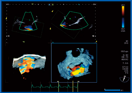 図7　症例2：僧帽弁の3Dカラードプラ画像