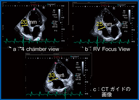 図10　撮像断面による右室基部径の比較