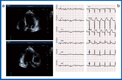 図3　症例2：たこつぼ型心筋症疑い a：心エコー　b：心電図