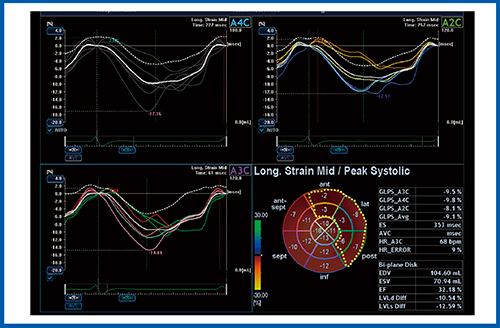 図6　症例3のlongitudinal strain