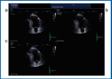 図7　症例4の2 chamber view a：baseline　b：peak stress　c：recovery