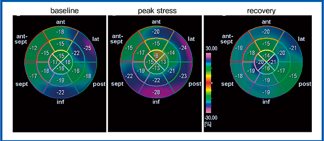 図8　症例4の運動負荷後のlongitudinal strainの変化