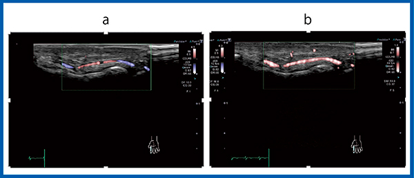 図1　SMIとADFによる描出能の違い a：ADF　b：SMI SMIを用いることにより微細な血流評価が可能となった。