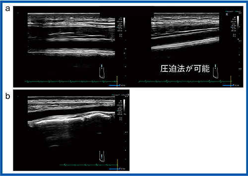 図5　ホッケースティック型22MHzリニアプローブ PLI-2002BTの画質 a：前脛骨動脈　b：足背動脈 プローブの形状を生かした圧迫法が可能である。