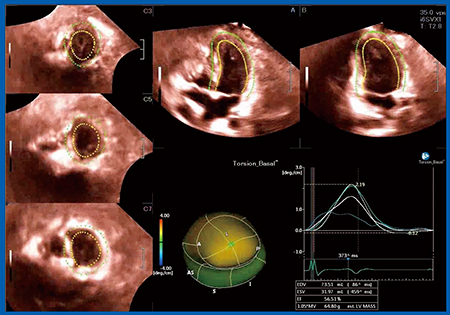 図3　体循環心室左室の3D-WMTによるねじれの解析