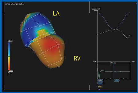 図5　Quad Chamber Tracking：HLHSの左房と右室