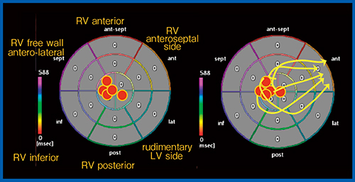 図7　Activation Imagingによる体循環心室右室の興奮伝搬（HLHS 5例）