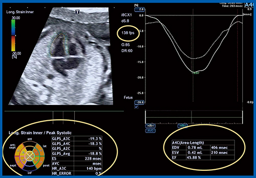 図9　胎児心エコーでの左室global longitudinal strain計測