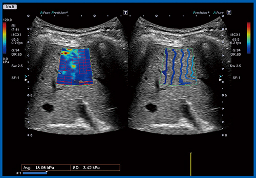 図10　肝臓エラストグラフィ〔三尖弁閉鎖症，21歳のFontan関連肝疾患（FALD）例〕
