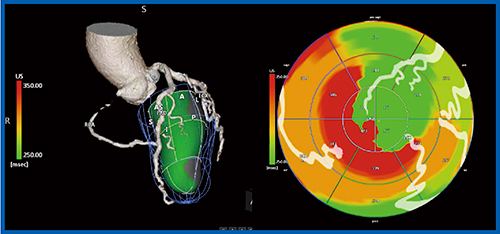 図5　症例2：US Cardiac Fusion