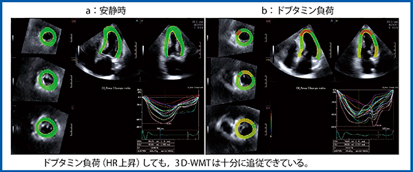 図6　症例3：労作性狭心症（EAP）の3D-WMT