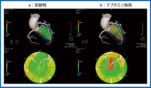 図7　症例3：US Cardiac Fusion