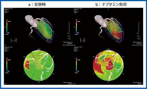 図8　症例4：急性非代償性心不全症例のUS Cardiac Fusion