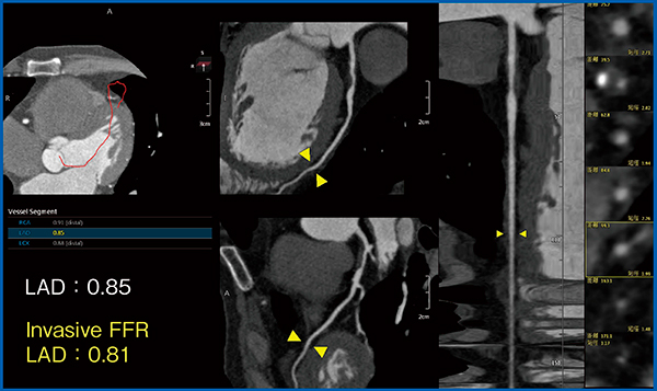 図2　症例提示：CT-FFR