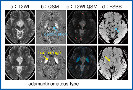 図5　症例5：QSMによる頭蓋咽頭腫の出血および石灰化の評価