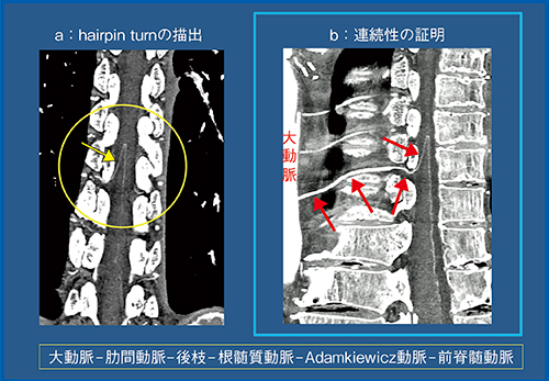 図1　Adamkiewicz動脈の大動脈から前脊髄動脈までの連続性の証明