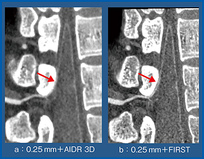 図3　スライス厚 0.25mmにおけるAIDR 3D（a）とFIRST（b）の比較